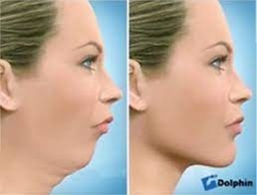 Cirurgia Bucomaxilofacial