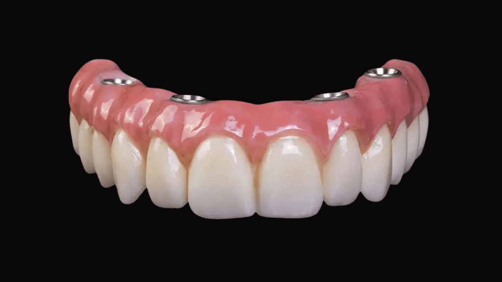 Prótese Protocolo cerâmico