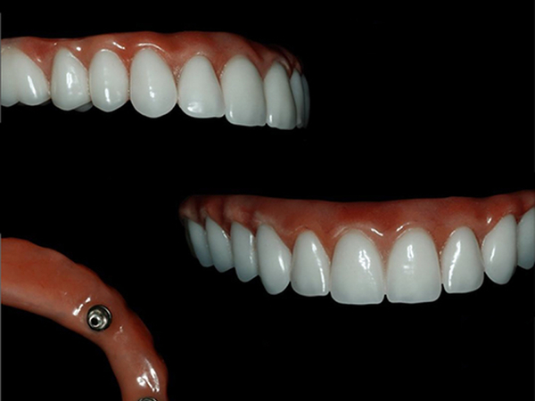 Prótese Protocolo convencional